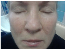 Купероз лица через 3 недели после лечения лазером Лахта-Милон