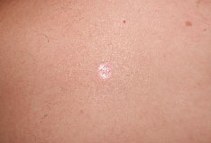 Дерматофиброма на спине удалена лазером Лахта-Милон