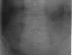 Рентгенограмма пояснично-крестцового отдела позвоночника при чрезкожной лазерной вапоризации протрузии или грыжи межпозвонкового диска (прямая проекция) иглы установлены в полости межпозвонковых дисков, лазерный аппарат ЛАХТА-МИЛОН
