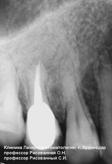 Рентгеновский снимок 15 зуба через два года после лечения, фотосенсибилизатор радахлорин, лазерный аппарат ЛАХТА-МИЛОН