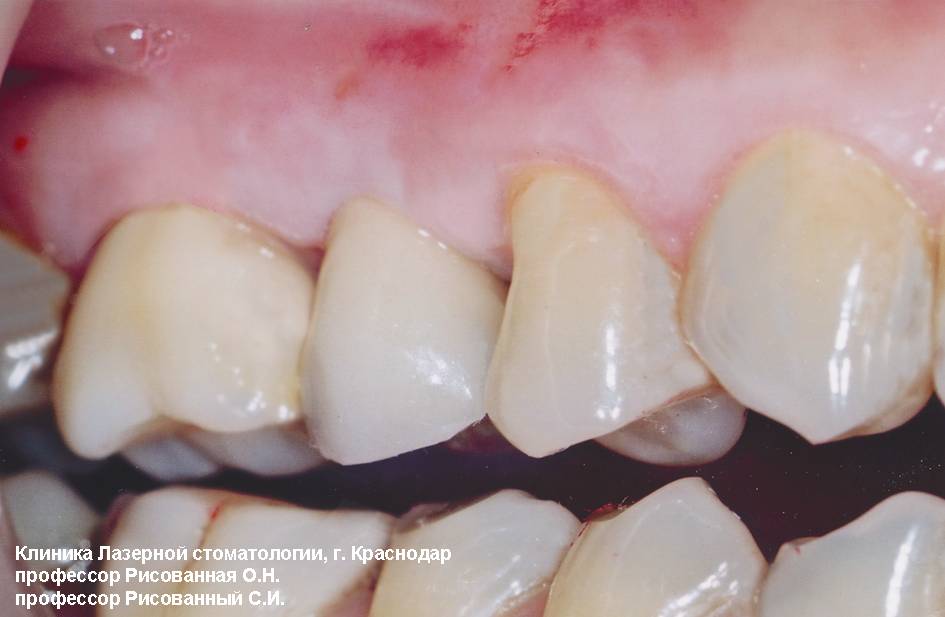 Состояние полости рта в области 15 зуба через два года после БТС-терапии, фотосенсибилизатор радахлорин, лазерный аппарат ЛАХТА-МИЛОН