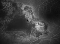 Флюоресцентная ангиограмма меланомы хориодеи того же пациента через 4 месяца после транспупиллярной диод-лазерной термотерапии, лазерный аппарат МИЛОН-ЛАХТА