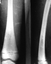 Бедренная кость через 11 месяцев после лазерной остеоперфорации, лазерный аппарат ЛАХТА-МИЛОН, лазерный аппарат ЛСП