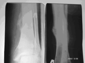 Большеберцовая кость через 2 месяца после лазерной остеоперфорации, лазерный аппарат ЛАХТА-МИЛОН, лазерный аппарат ЛСП
